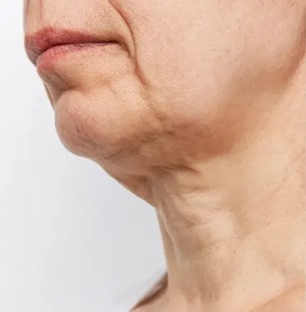Sagging Skin